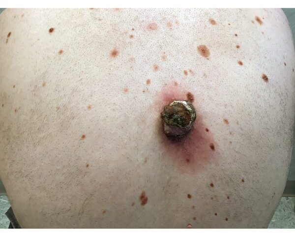 Melanoma case study