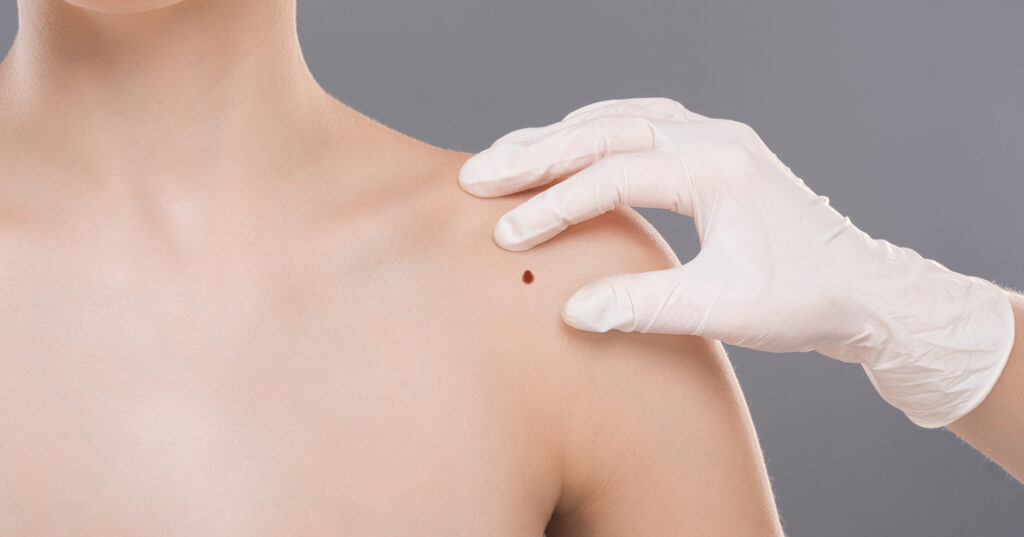 Our expert discusses the pain that may be associated with excisional surgery and Mohs Surgery, the most commonly recommended treatment options for early-stage skin cancers.