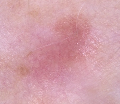 melanoma on leg