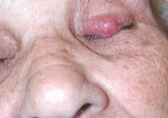 merkel-1-qa Merkel cell carcinoma on senior woman left eyelid
