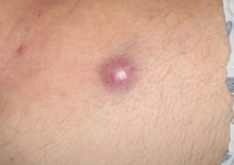 merkel-cell-arm merkel cell carcinoma on arm