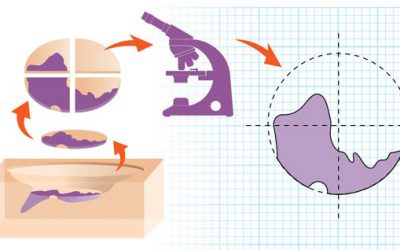 MohsBro-web-illo-3 Mohs Surgery Graphic