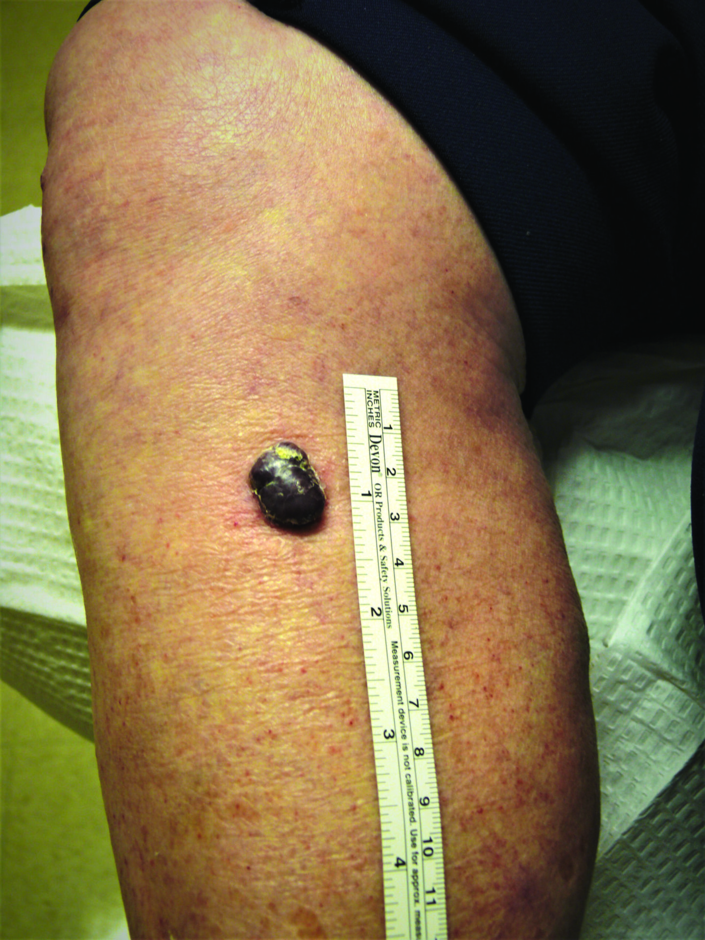 Nodular mm leg native American woman