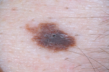 atypical-mole-ABC picture atypical mole
