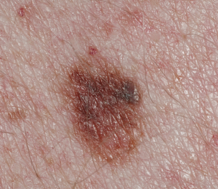 atypical-mole atypical mole