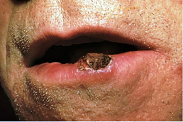 Squamous Cell Carcinoma 3 elevated growth on lip